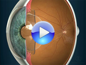 Dinkarville dirección Catarata Preguntas sobre lentes intraoculares