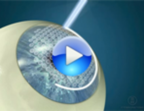 Benefits of Femtosecond laser