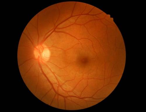 Conditions of the retina