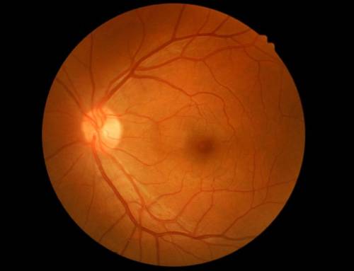 Ocular hypertension and glaucoma