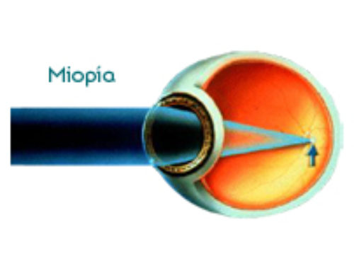 Myopia