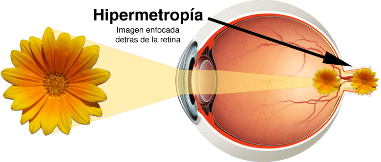 viziune protetică oculară îmbunătăți vederea prin nutriție