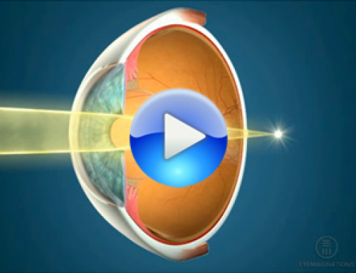 Cirugía láser para astigmatismo