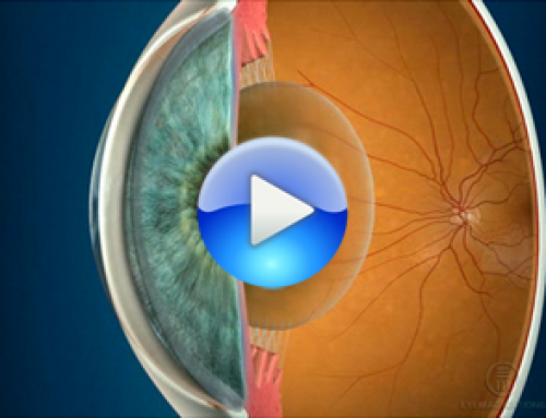 Cataracts