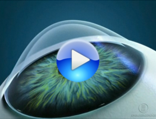 Keratoconus