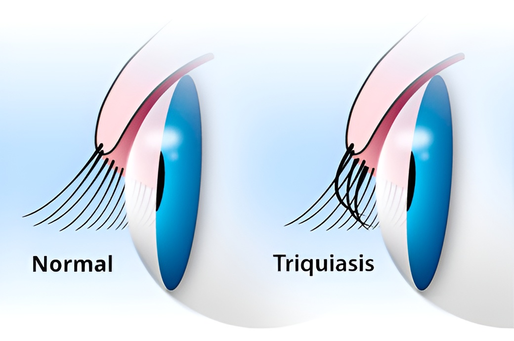 parpado con triquiasis