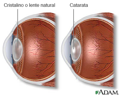 Catarata y cristalino