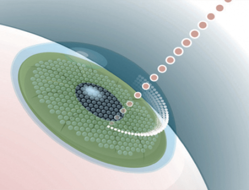 Opération des yeux au laser pour myopie