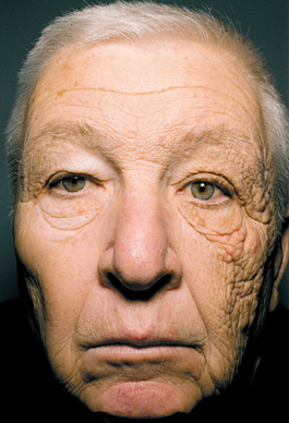 daños del sol en la piel