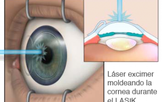 Significado de lasik Archivos - Vistaláser Oftalmología