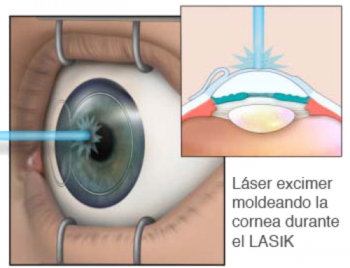 Operación con LASIK teniendo blefaritis