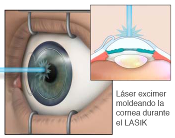 LASIK