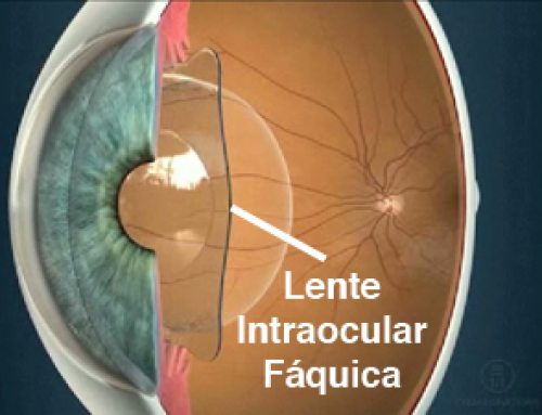 Visian ICL, lentes intraoculares fáquicas