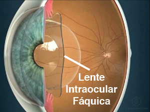 lente intraocular faquica