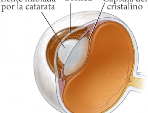 Cataratas en los ojos
