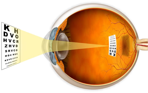 miopia este responsabilă de gene restaurarea vederii oculare