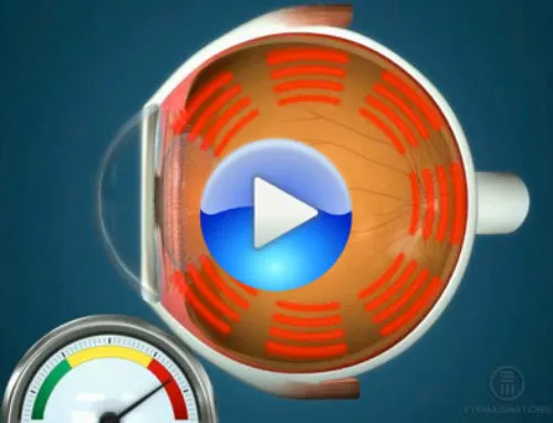 Ocular hypertension and glaucoma