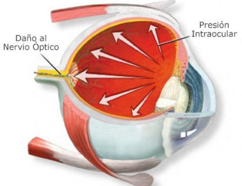 La Tensión Ocular