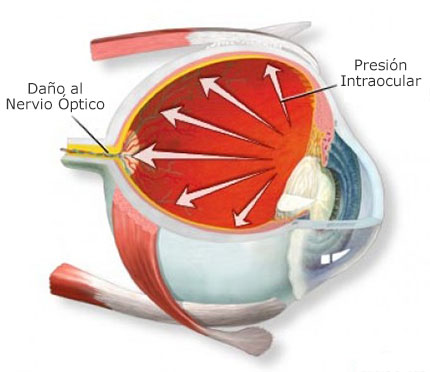 Tensión ocular