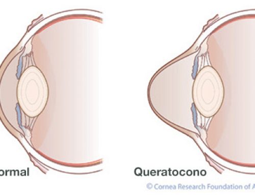 Cross-linking corneal para Queratocono