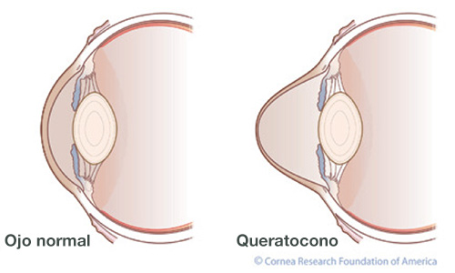 síntomas del queratocono