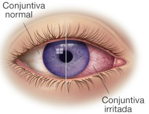 Conjuntivitis en verano