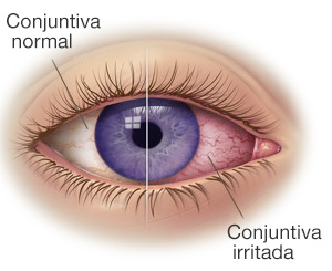 Conjuntivitis en verano - Vistaláser Oftalmología