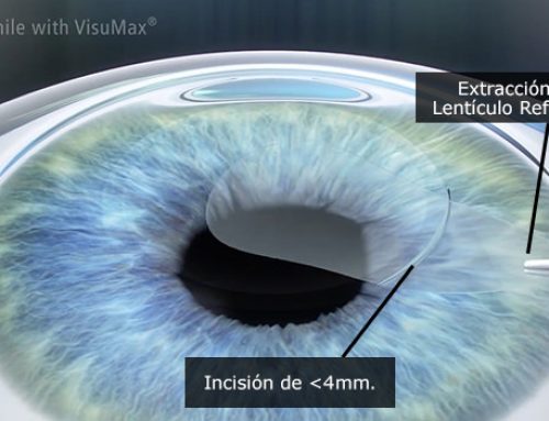 SMILE vs LASIK