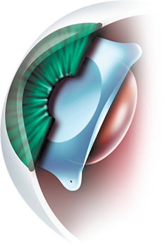 myopia lézer