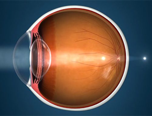 Cirugía refractiva para astigmatismo