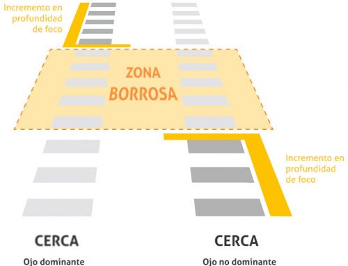 Monovisión con lentes intraoculares
