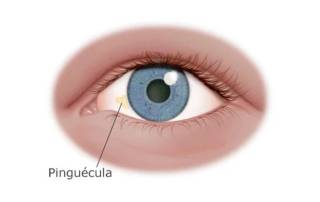 pinguecula en el ojo