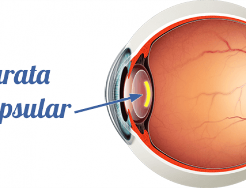 Catarata subcapsular