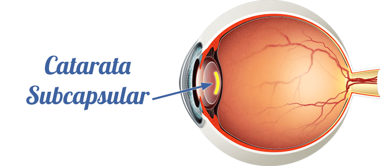 Catarata subcapsular