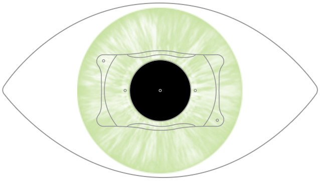 lente intraocular ICL