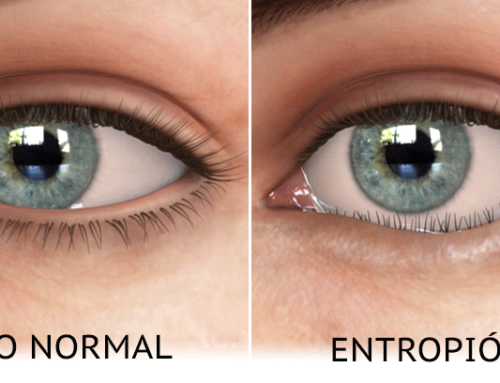 Entropion: symptoms and treatment