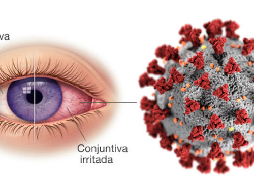 Conjuntivitis como síntoma de COVID-19