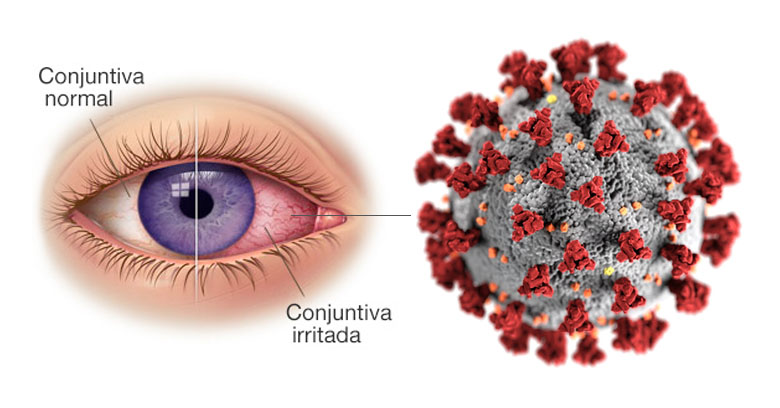 Conjuntivitis como síntoma de COVID-19