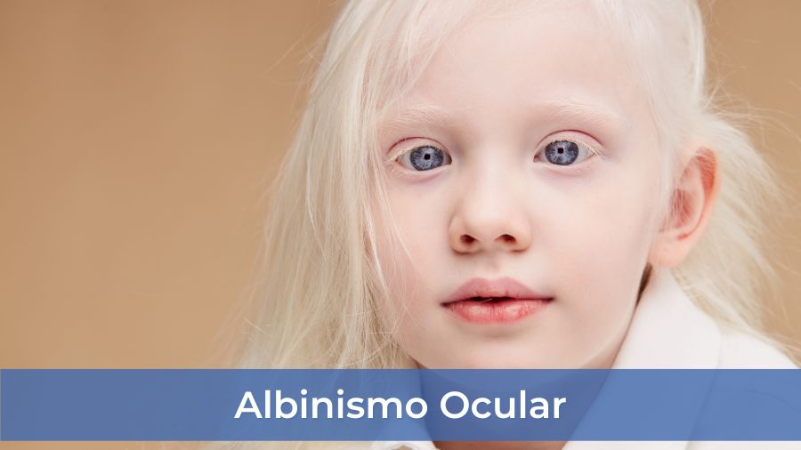 albinismo ocular