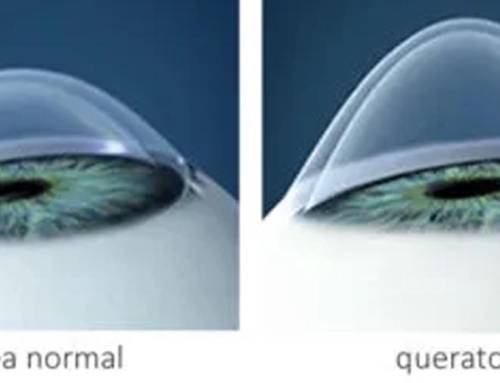 Keratoconus