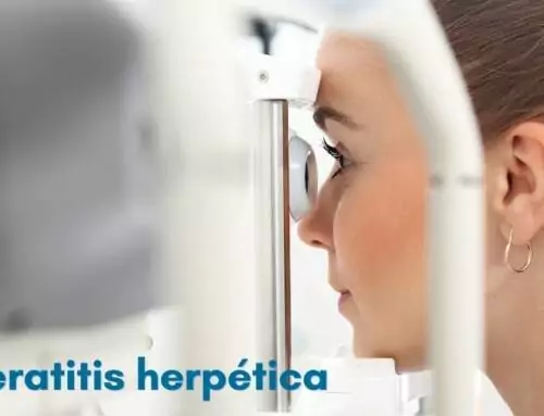 Queratitis herpética