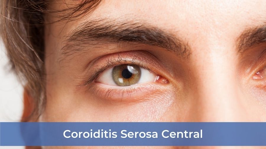 Coroiditis Serosa Central