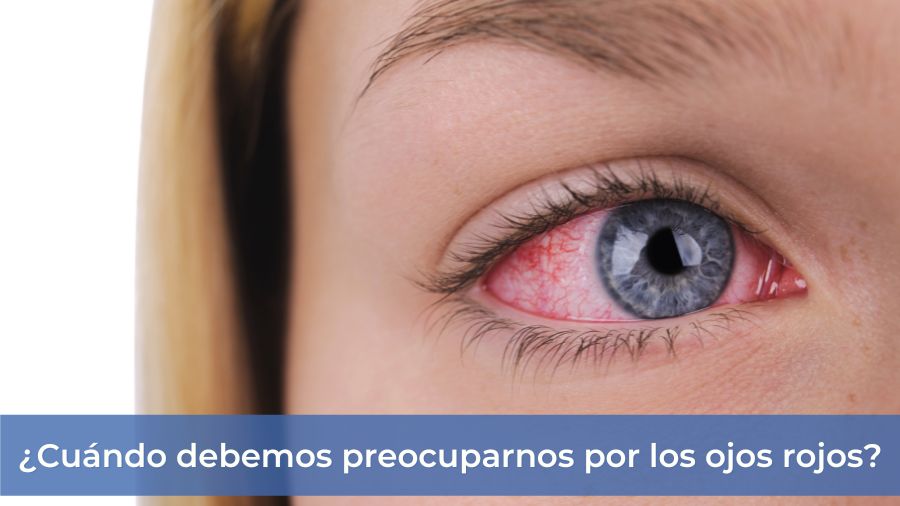 Ojos rojos varios dias