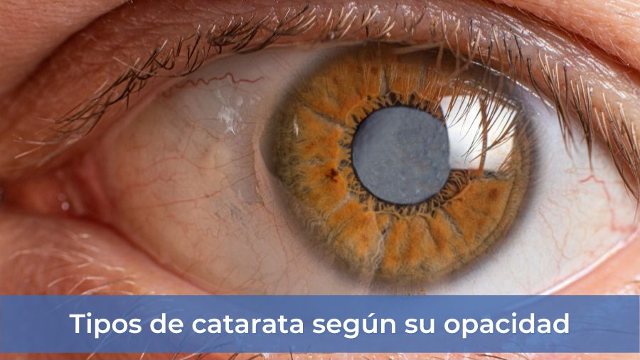 ¿Qué son las cataratas? Causas, síntomas y tratamiento