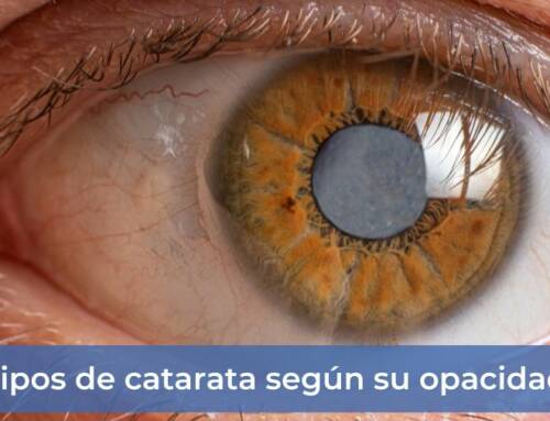 Tipos de catarata según su opacidad