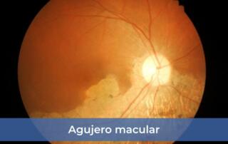 Agujero macular