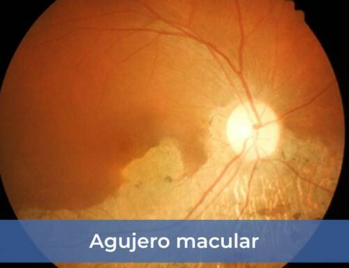 Agujero macular
