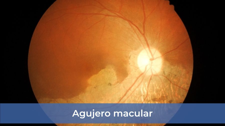 Agujero macular