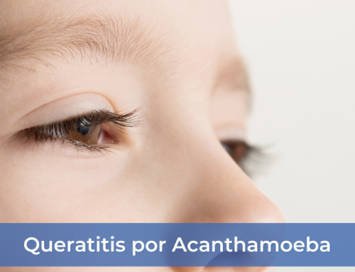 Queratitis por Acanthamoeba