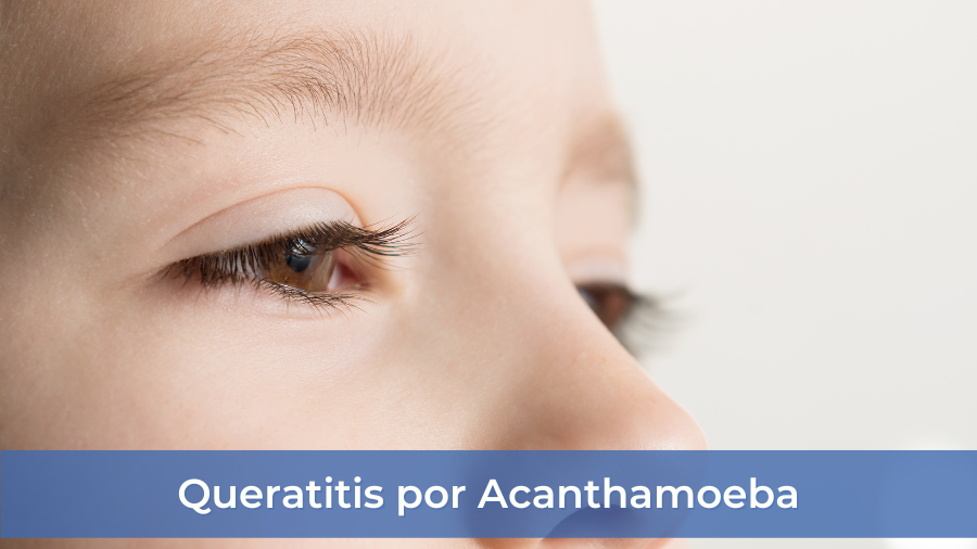 Queratitis por Acanthamoeba